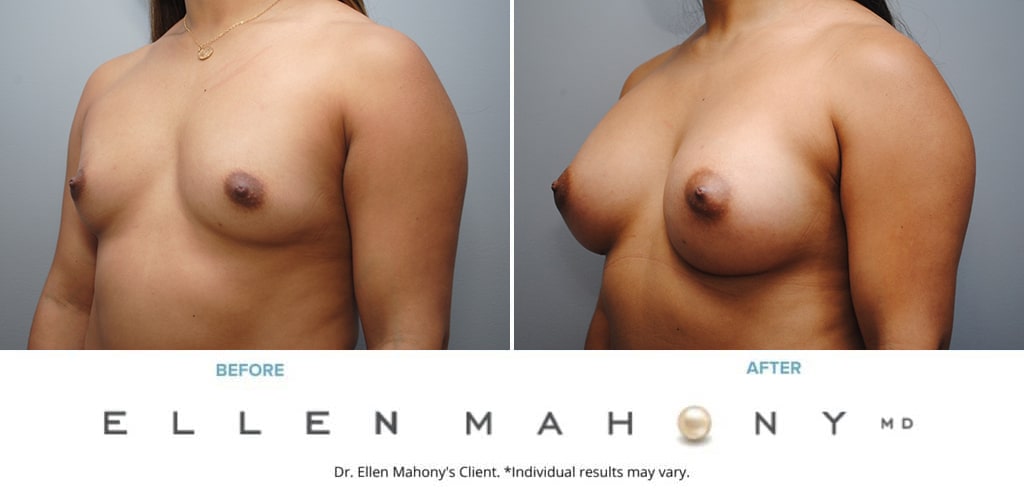 Before and After Image: Case #9331 - left-front-oblique