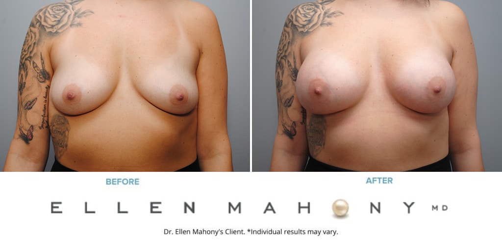 Before and After Image: Case #9355 - front