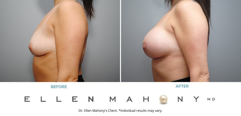 Before and After Image: Case #9355 - left-side