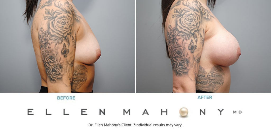 Before and After Image: Case #9355 - right-side