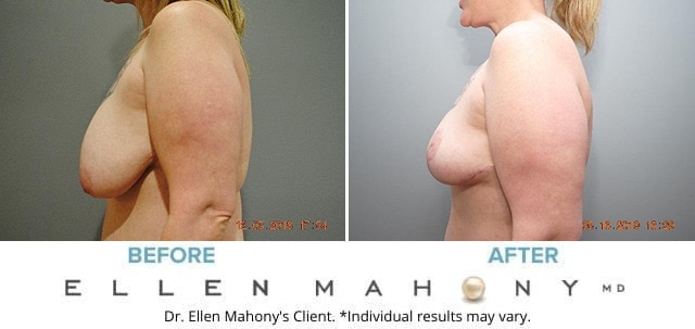 Before and After Image: Case #4289 - left-side