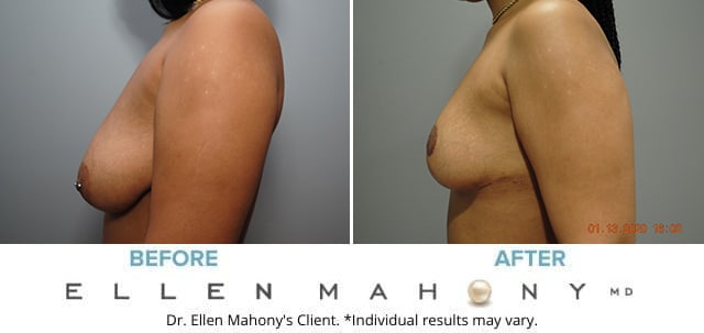 Before and After Image: Case # 8645 - left-side