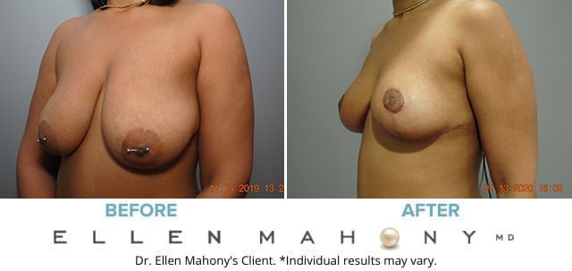 Before and After Image: Case # 8645 - left-front-oblique