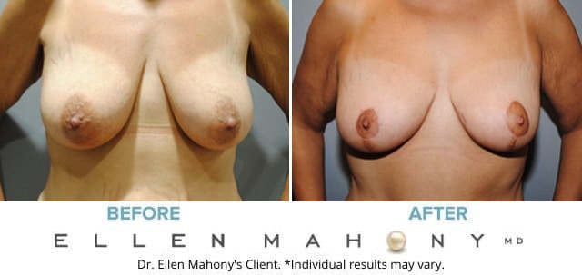Before and After Image: Case #6310-1 - front