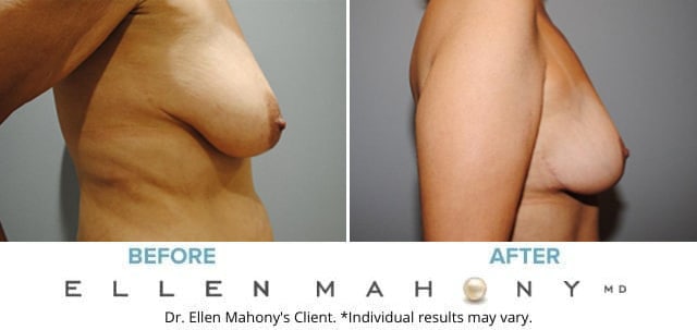 Before and After Image: Case #6310-1 - right-side