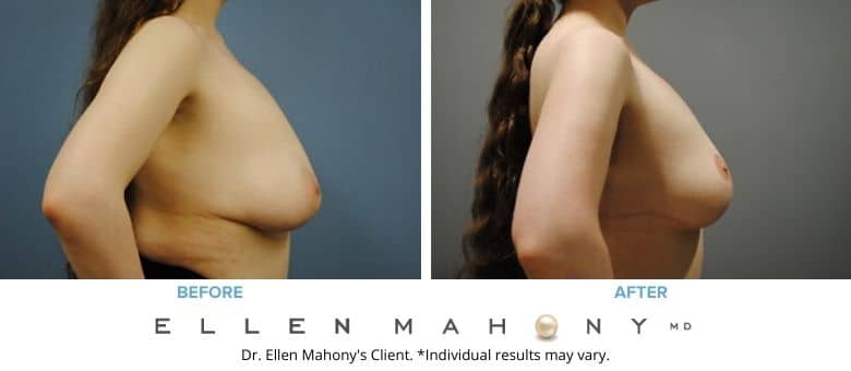Before and After Image: Case #2664 - right-side