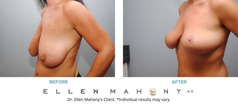 Before and After Image: Case #2671 - left-front-oblique