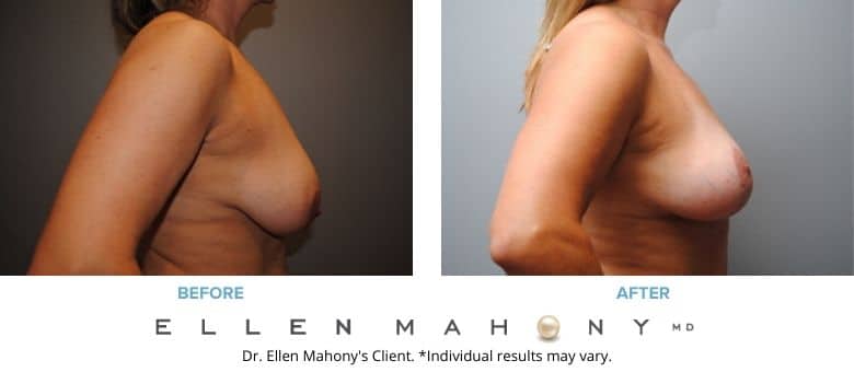 Before and After Image: Case #2678 - right-side