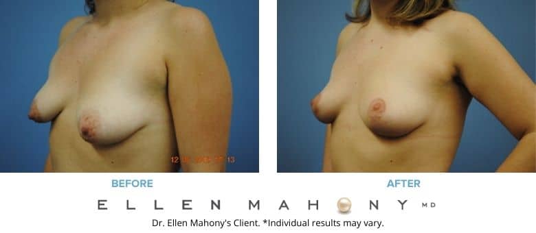 Before and After Image: Case #2685 - left-front-oblique