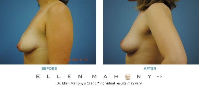 Before and After Image: Case #2685 - left-side