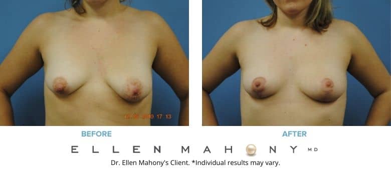 Before and After Image: Case #2685 - front
