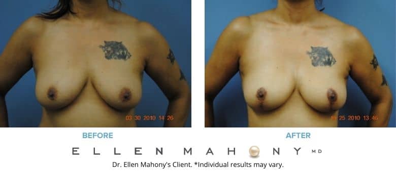 Before and After Image: Case #2706 - front