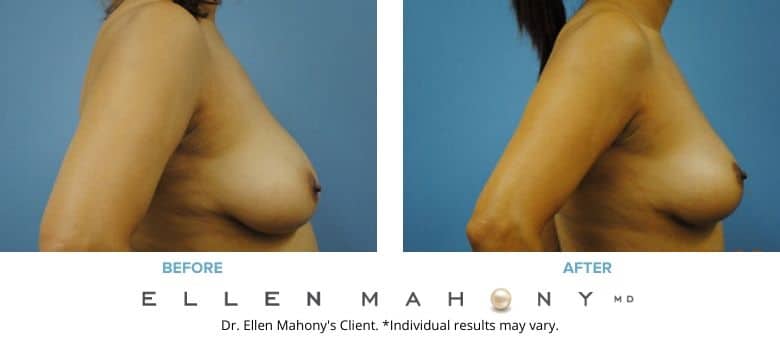 Before and After Image: Case #2706 - right-side