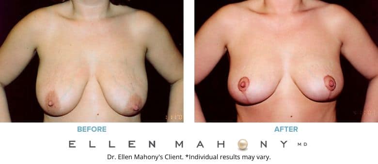Before and After Image: Case #2716 - front