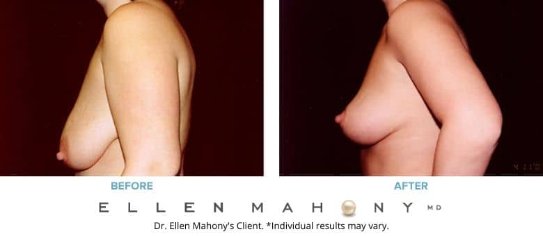 Before and After Image: Case #2716 - left-side