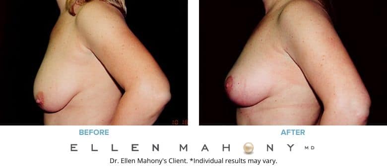 Before and After Image: Case #2723 - left-side