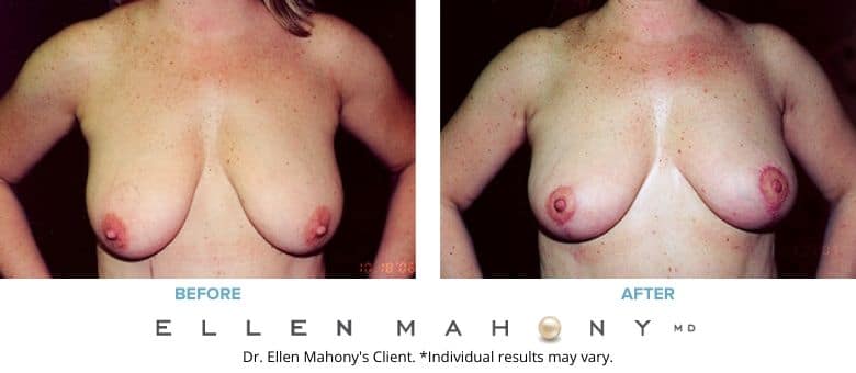 Before and After Image: Case #2723 - front