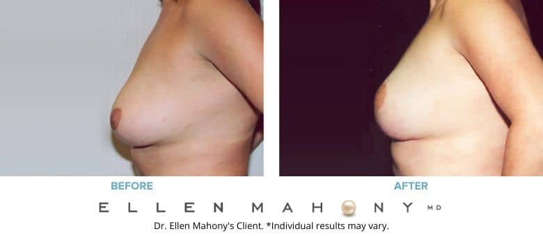Before and After Image: Case #2730 - left-side