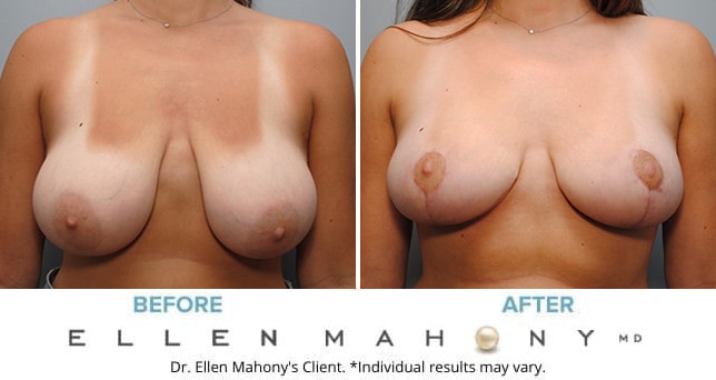 Before and After Image: Case #9115 - front
