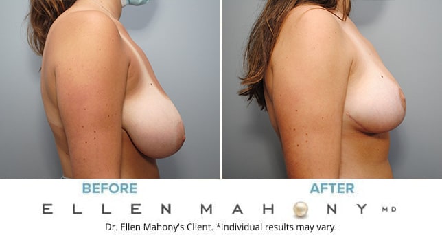 Before and After Image: Case #9115 - right-side