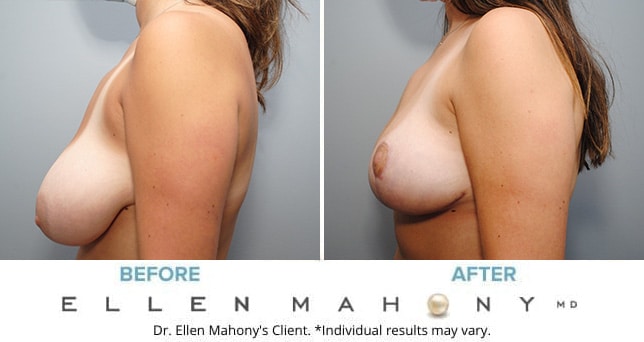 Before and After Image: Case #9115 - left-side