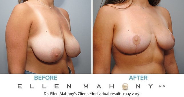 Before and After Image: Case #9115 - right-front-oblique