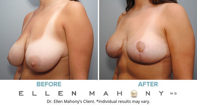 Before and After Image: Case #9115 - left-front-oblique