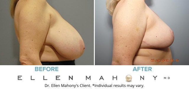 Before and After Image: Case #7094 - right-side