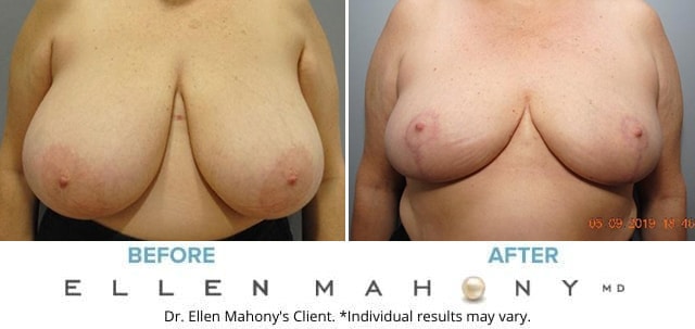 Before and After Image: Case #7094 - front