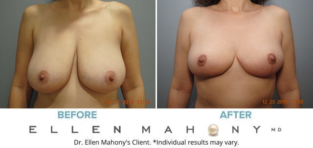 Before and After Image: Case #7810 - front