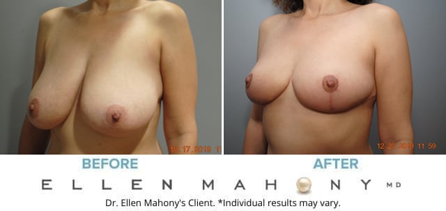 Before and After Image: Case #7810 - left-front-oblique