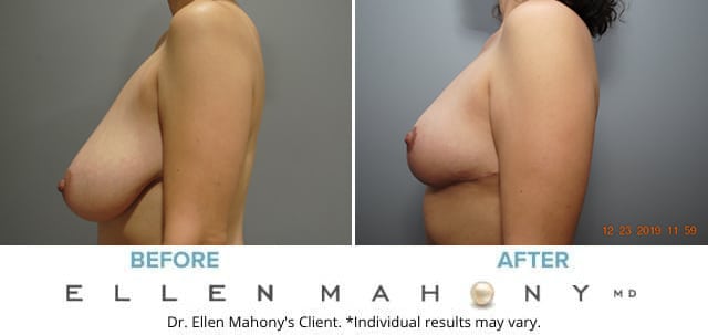 Before and After Image: Case #7810 - left-side