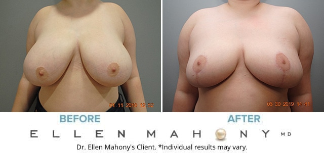 Before and After Image: Case #7882 - front