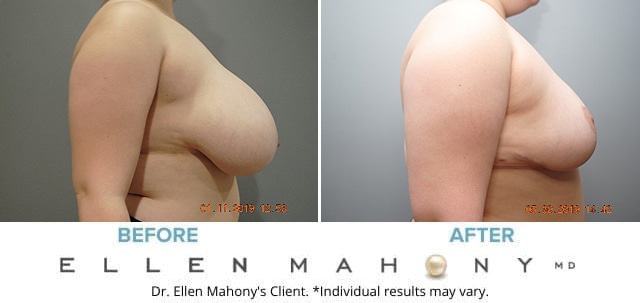 Before and After Image: Case #7882 - right-side