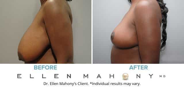 Before and After Image: Case #7887 - left-side