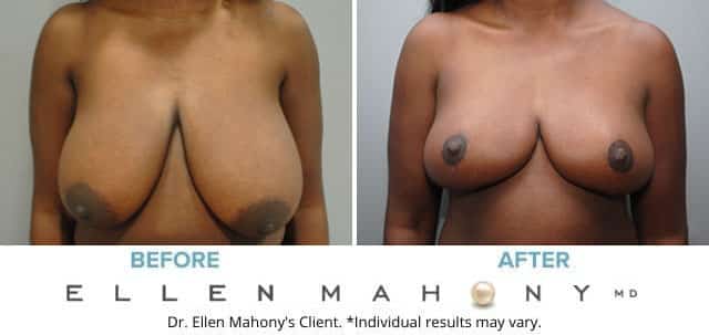 Before and After Image: Case #7887 - front