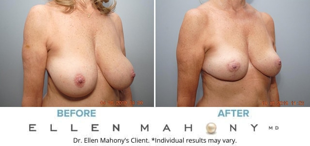 Before and After Image: Case #8908 - right-front-oblique