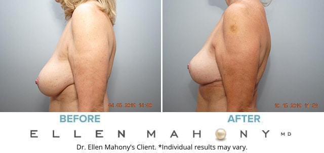 Before and After Image: Case #8908 - left-side