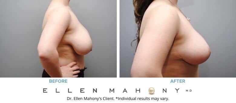 Before and After Image: Case #2563 - right-side