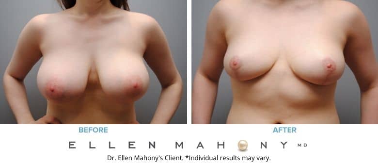 Before and After Image: Case #2570 - front