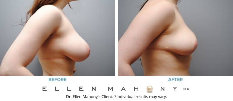 Before and After Image: Case #2570 - right-side