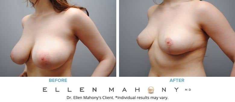 Before and After Image: Case #2570 - left-front-oblique