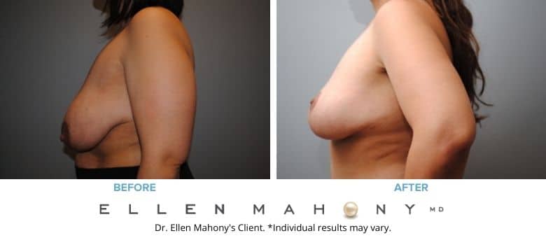Before and After Image: Case #2577 - left-side