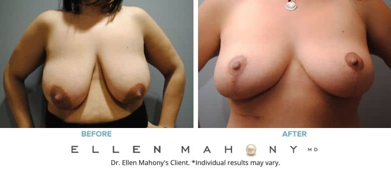 Before and After Image: Case #2577 - front