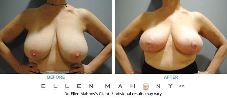 Before and After Image: Case #2584 - front