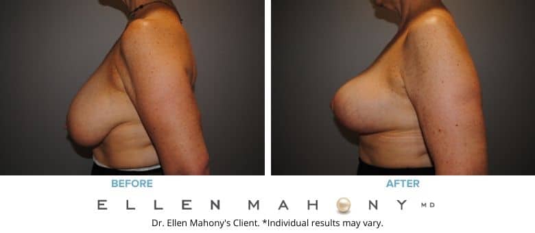 Before and After Image: Case #2584 - left-side