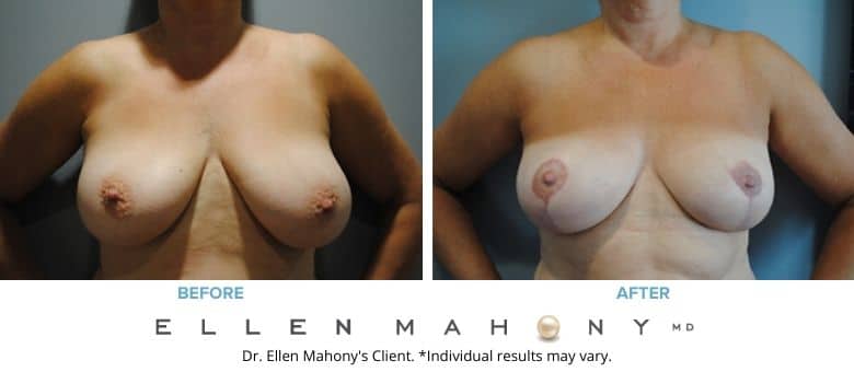 Before and After Image: Case #2595 - front