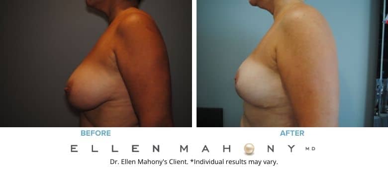 Before and After Image: Case #2595 - left-side