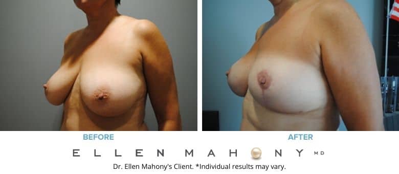 Before and After Image: Case #2595 - left-front-oblique