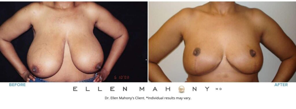 Before and After Image: Case #2606 - front